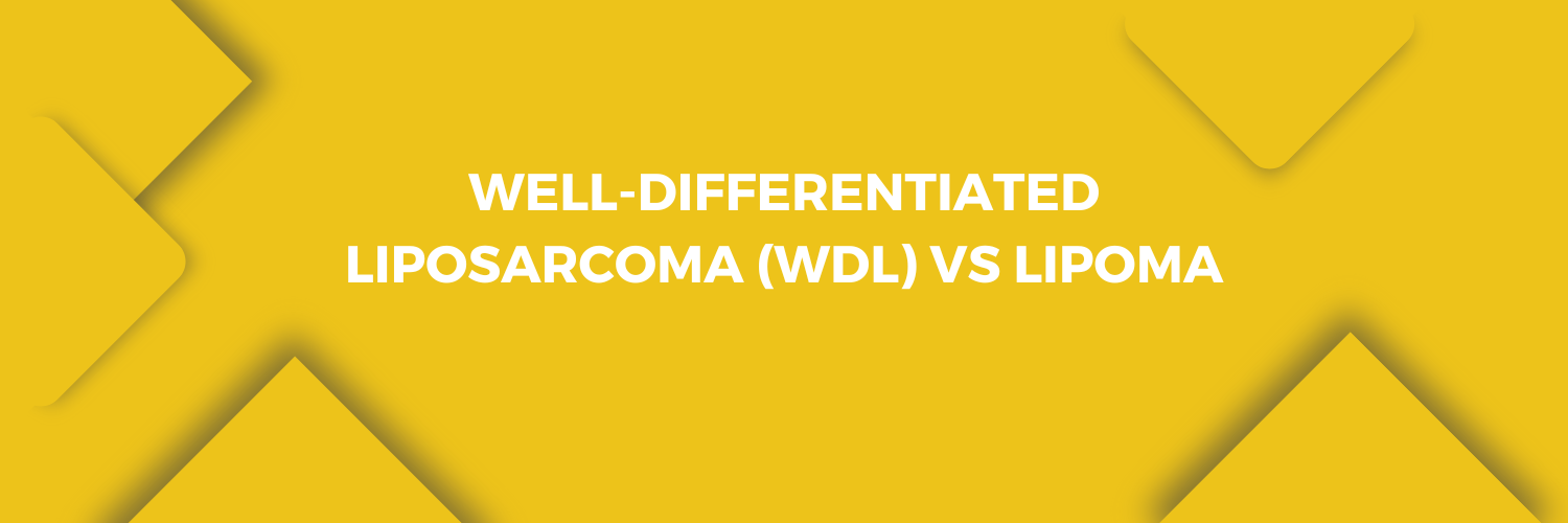 Well-Differentiated Liposarcoma (WDL) VS Lipoma